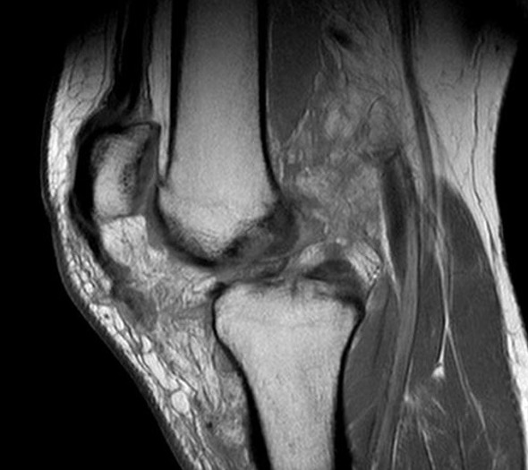 Knee dislocation patella tendon rupture